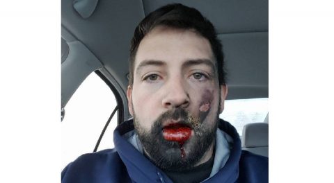 Uwaga na „wybuchowe” e -papierosy. Ten mężczyzna stracił 7 zębów i doznał licznych obrażeń