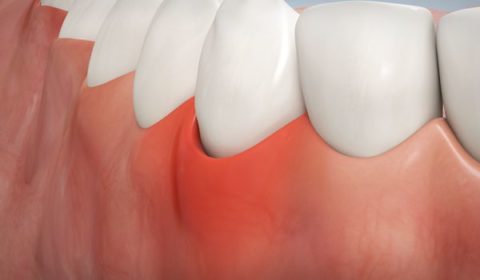 Tajwańscy naukowcy dowodzą, że paradontoza ma związek z ryzykiem rozwoju choroby Alzheimera