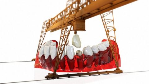 Implanty zębów – dlaczego warto w nie zainwestować?